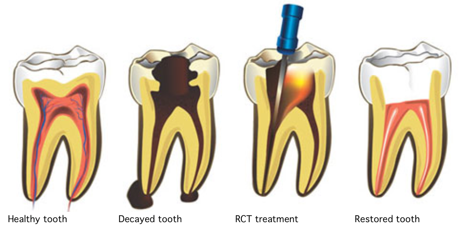 root-canal-treatment-elite