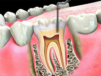Root Canal Specialist in Noida